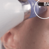 Dermasuction Pore Cleaning Device