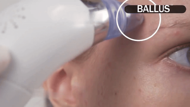 Dermasuction Pore Cleaning Device